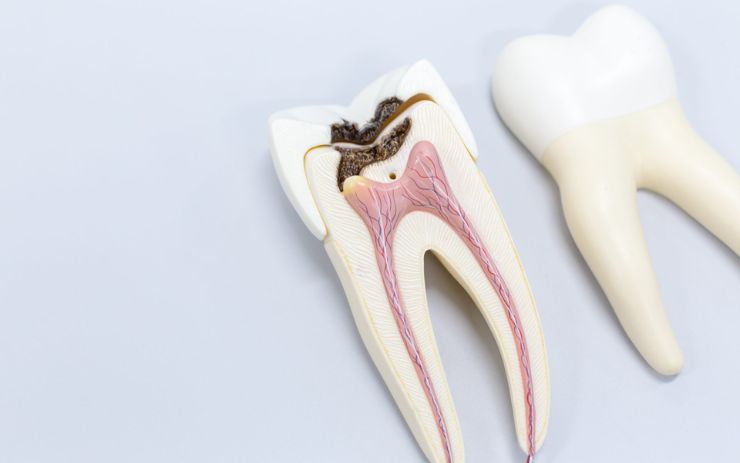 Root Canal Treatment in Agra